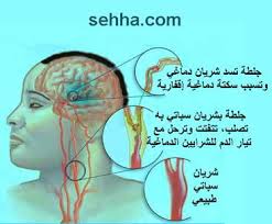 دراسة علمية : المدمنون على العمل الاكثر اصابة بالجلطات الدماغية